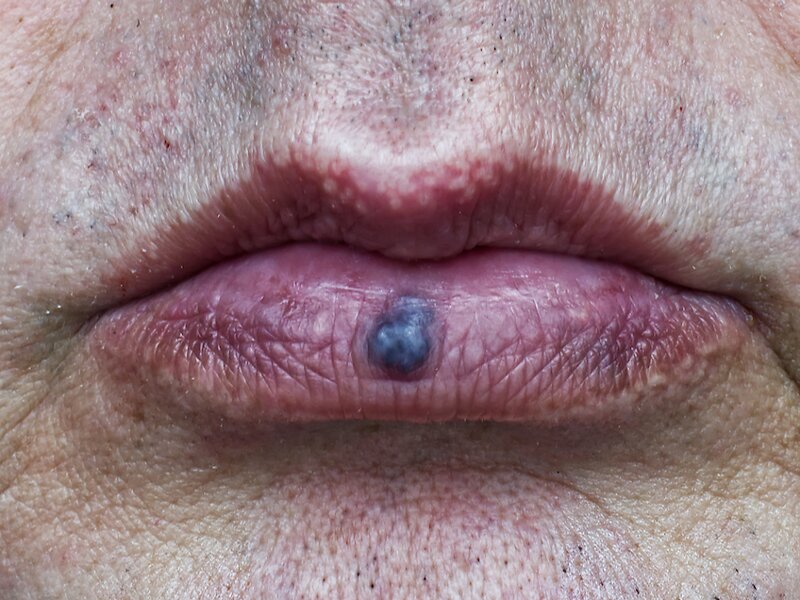 Voorbeeld van bloedblaar op de lip