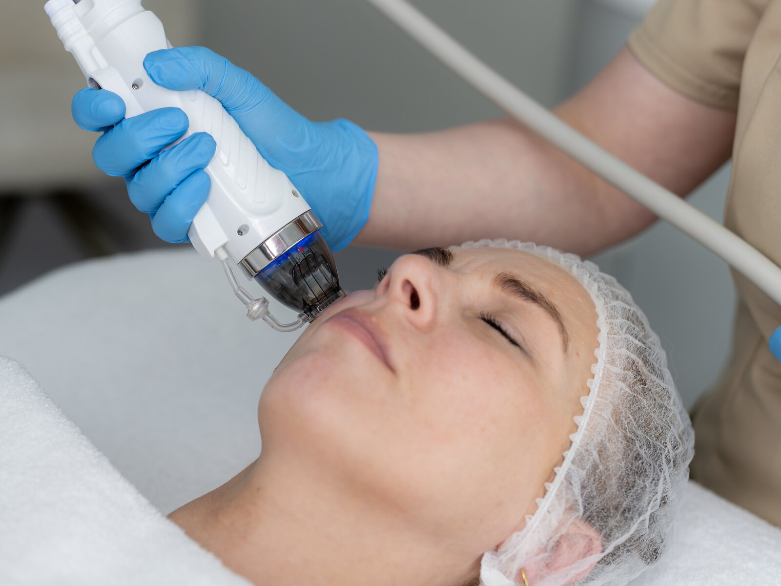 RF Micro Needling