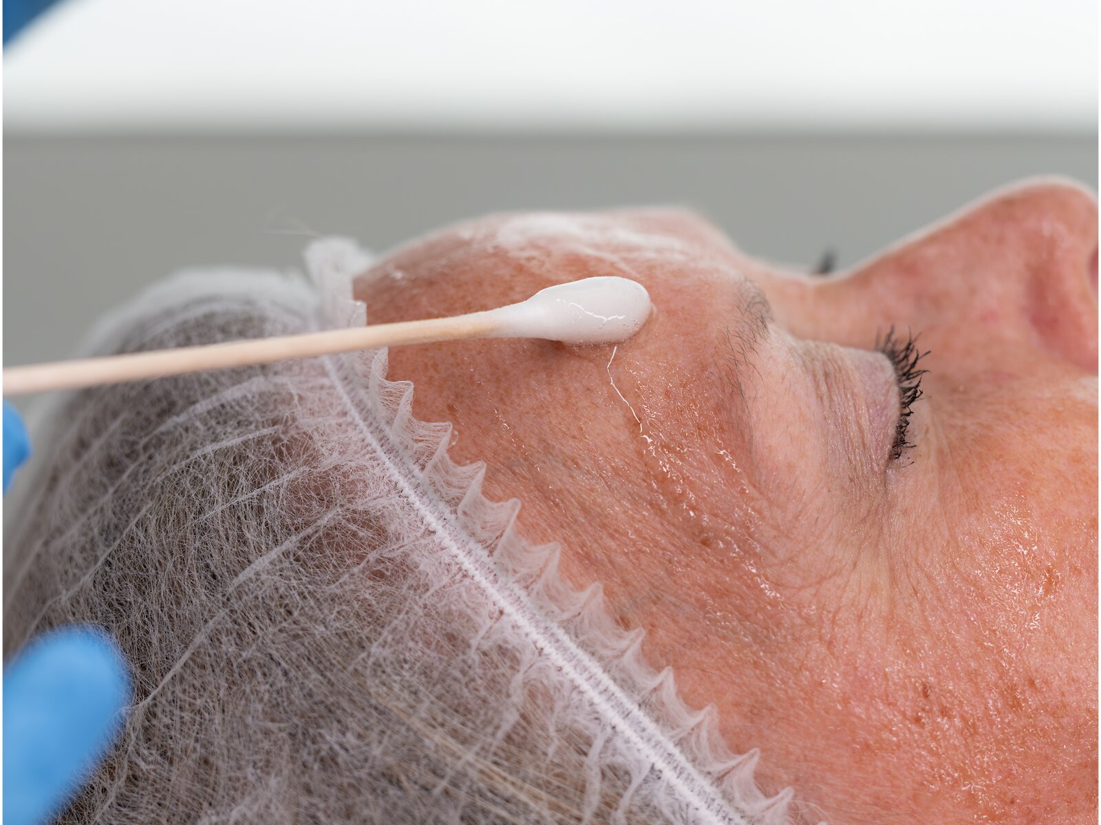 Medische Peeling