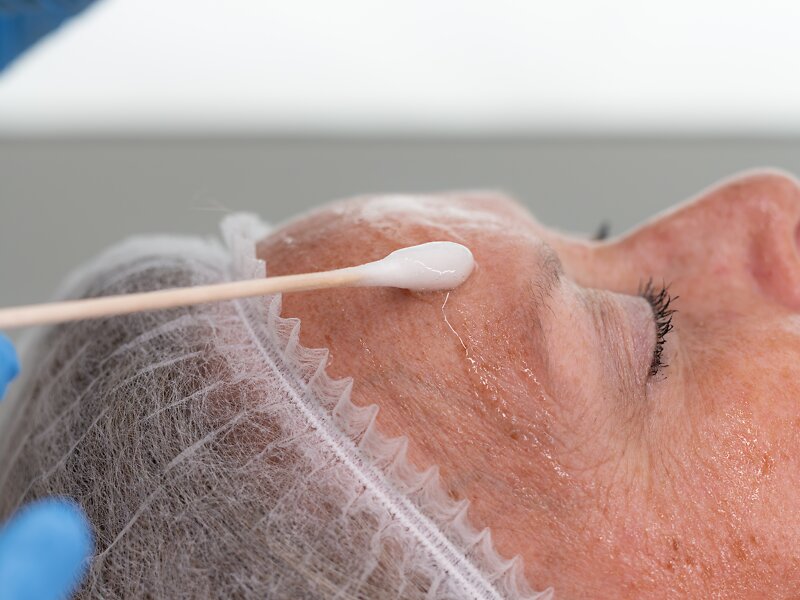 Medische Peeling
