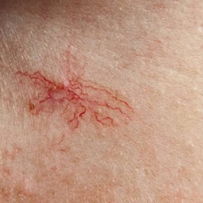 Voorbeeld: spinnetjes en bloedvaatjes